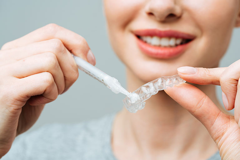 Bleaching-Patientin trägt Bleaching-Gel auf die Zahnschiene auf für ein professionelles Home Bleaching